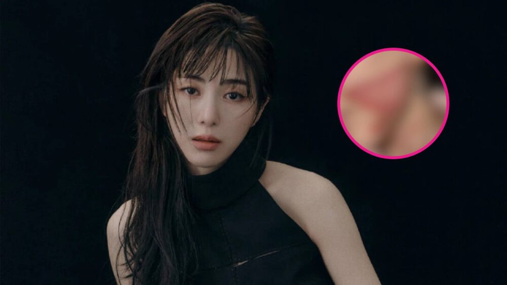 kwon-mina-ex-aoa-revela-quemaduras-tras-un-procedimiento-estetico-unniepop